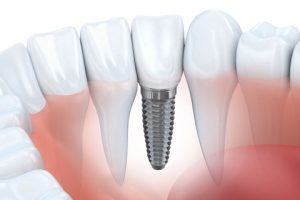 dental-implants-adelaide